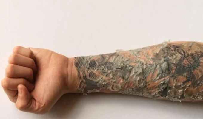 پوسته شدن، خارش و التهاب بعد از تتو